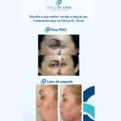 Fios PDO e Lipo De Papada 