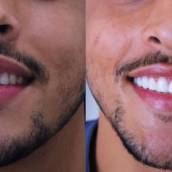 Facetas Em Resinas 