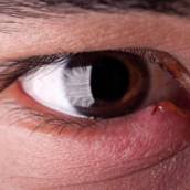 CIRURGIA DAS VIAS LACRIMAIS