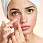 Tratamento Para Equilíbrio de Oleosidade e Acne Facial