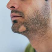 Tratamento de Alopecia Areata em Barba