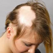 Alopecia Feminina e Masculina