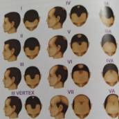 Tratamento para Alopecia Masculina