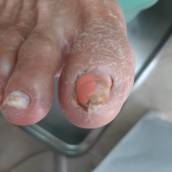 Tratamento de micose nos pés
