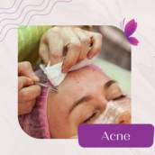 Tratamento para acne