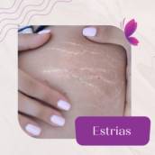 Estrias