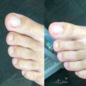 Unhas encravada 