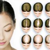 Alopecia Androgenética