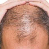 Alopecia Androgenética Masculina