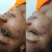 Peeling químico