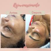 Rejuvenescimento