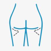 LIFTING CRURAL