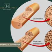 TRATAMENTO DE OSTEOPOROSE 
