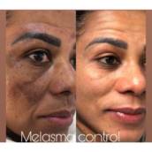 Tratamento de melasma