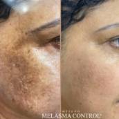 Tratamento facial