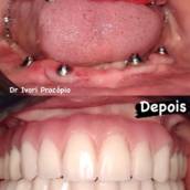 Implantes Dentários em São Paulo – Odonto Los Angeles