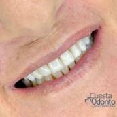Lentes em Resina Composta