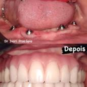 Implantes