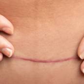Tratamento para Fibrose em Bauru