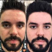 Clareamento de manchas senil