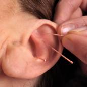 Auriculoterapia 