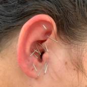 Auriculoterapia -  Acupuntura auricular 