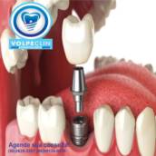 Implantes dentais