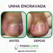 unha encravada, podoclinic, itatinga