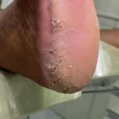 remossão de fissuras, podoclinic, itatinga