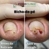 remoção de biccho de pé, podoclinic, itatinga
