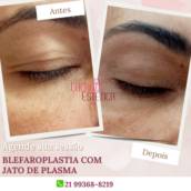 Blefaroplastia: Rejuvenesça Seu Olhar no Rio de Janeiro/RJ