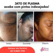 Remoção de pintas