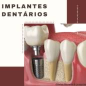 Implantes Dentários