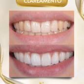 Clareamento