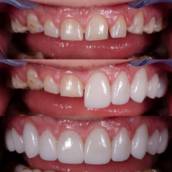 Recuperação Dentária