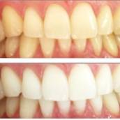 Clareamento Dental