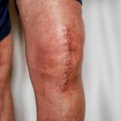 Cirurgia de Joelho