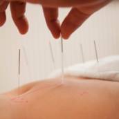 Acupuntura