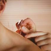 Acupuntura