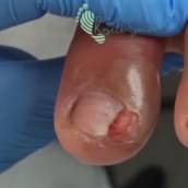 Onicocriptose (unha encravada)