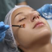 Peeling Químico em Bauru
