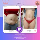 Tratamento para estrias