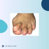 Tratamento pé reumático, vascular, neurológico