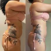 Lipo Enzimática