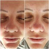 Microagulhamento Facial em Bauru