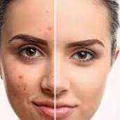 Tratamento de acne