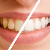 Clareamento dental
