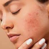 Tratamento de acne