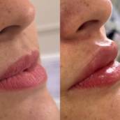 Preenchimento  Labial em Jundiaí