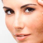 Tratamento para melasma em Jundiaí